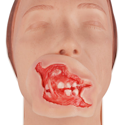 Wound Moulage – Maxillofacial Burn Wound Simulation Model
