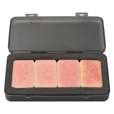 Realistic Stage 1-4 Facial Acne Model