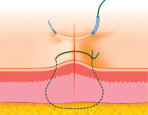 The Suturing Techniques Guide