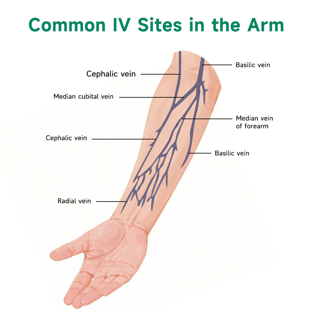 Common IV Sites in the Arm: Principles and Techniques