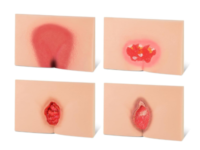 Four Stages of Pressure Ulcers