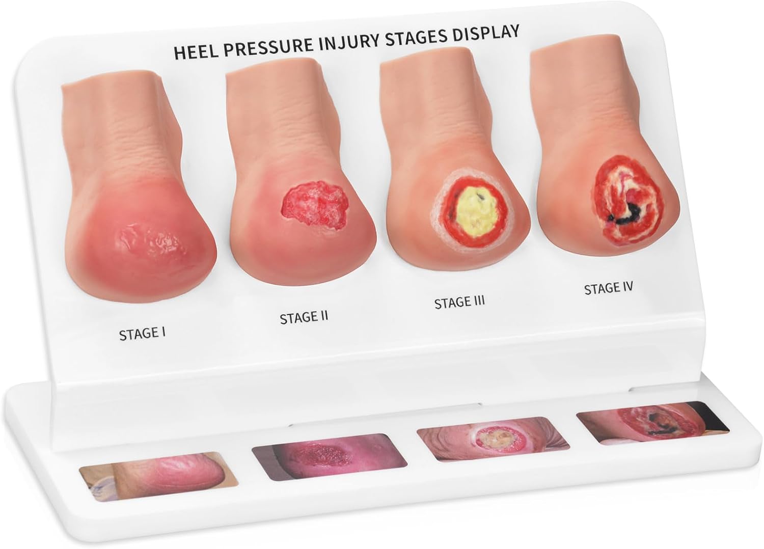 Heel Pressure Injury: Causes, Stages and Treatment