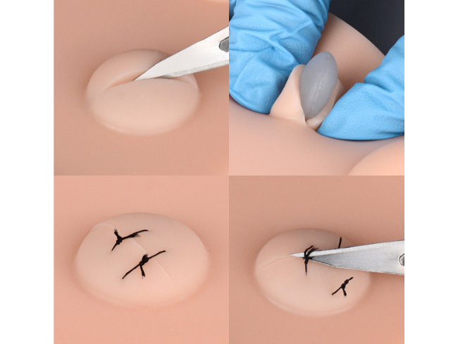 How to Drain and Treat an Abscess?