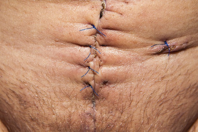 A Doctor's Abdominal Knife Stab Wound, Abdominal Wall Debridement and Suture Experience