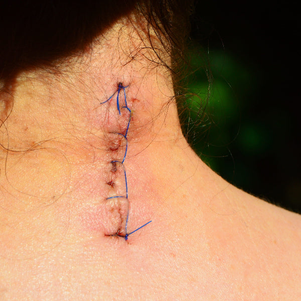 How Long Can the Wounds Be Removed After the Surgery