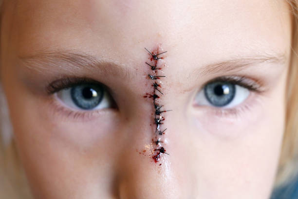Unveiling the Legacy and Application of Simple Interrupted Suture Technique in Medical Practice