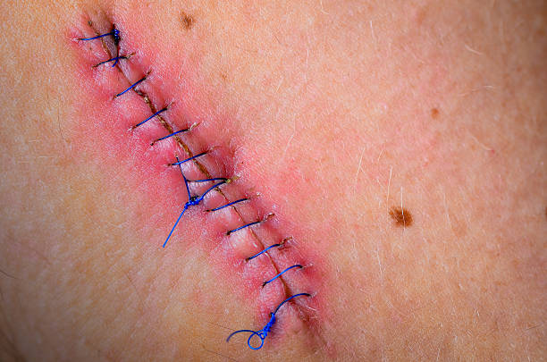 Suturing Technique Guide for Simple Running | Master the Art of Suturi ...