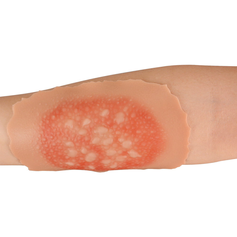 1st-4th Degree Skin Burn Wound Moulage