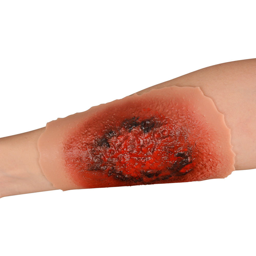 1st-4th Degree Skin Burn Wound Moulage