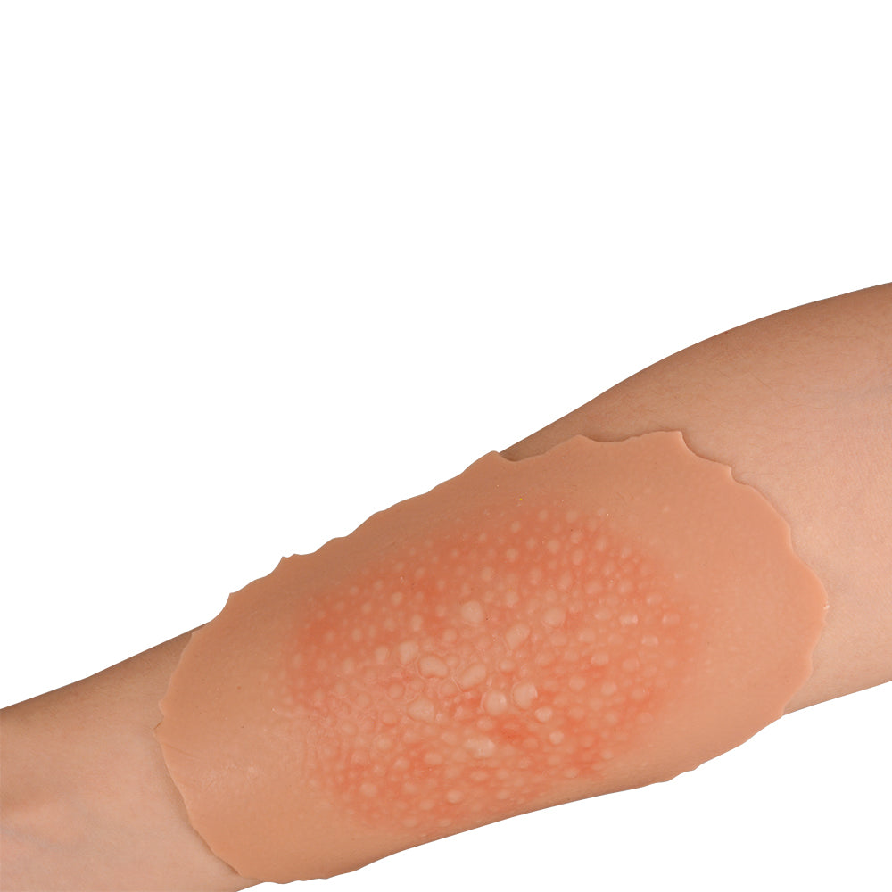 1st-4th Degree Skin Burn Wound Moulage