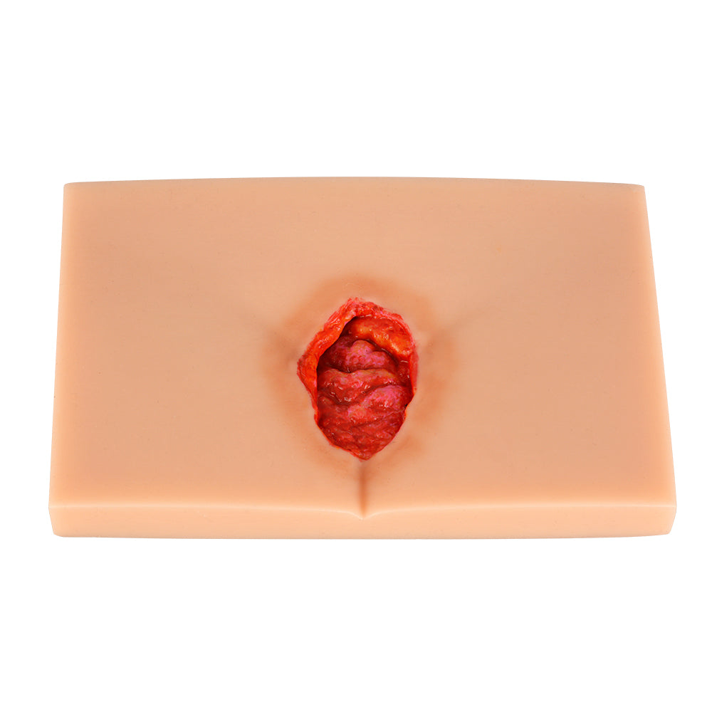 Pressure Ulcer/Bedsore Model Set(Stage 1-4) - [shop_medarchitect]