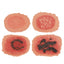 1st-4th Degree Skin Burn Wound Moulage