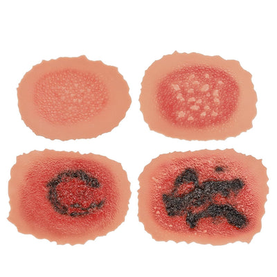 1st-4th Degree Skin Burn Wound Moulage