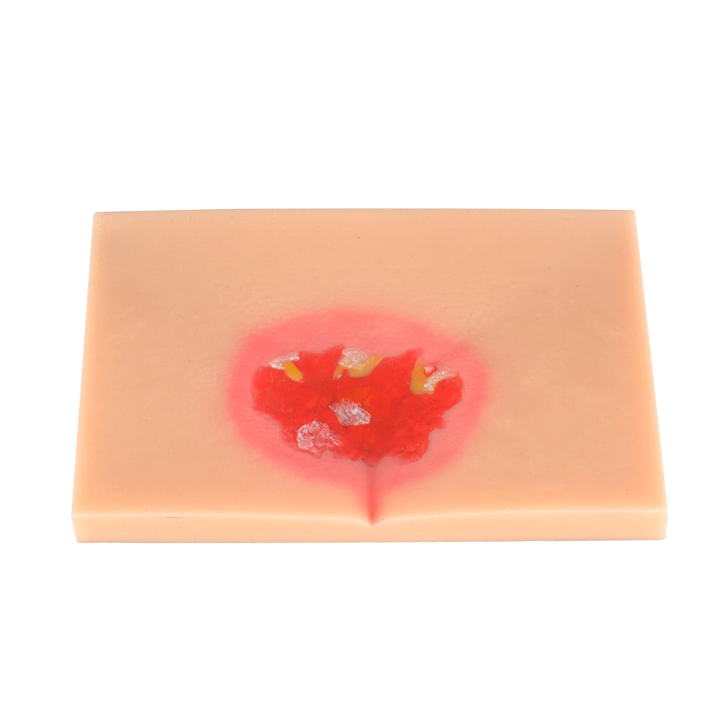 Pressure Ulcer/Bedsore Model Set(Stage 1-4) - [shop_medarchitect]