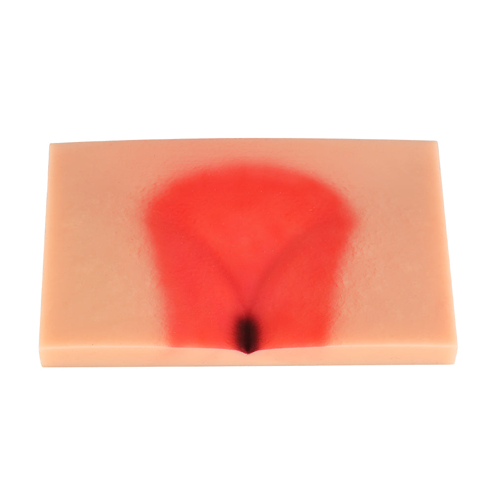 Pressure Ulcer/Bedsore Model Set(Stage 1-4) - [shop_medarchitect]