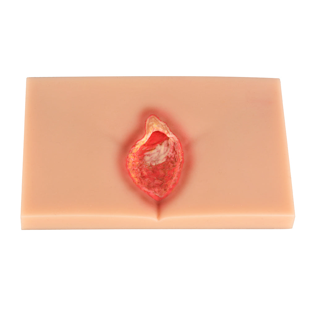 Pressure Ulcer/Bedsore Model Set(Stage 1-4) - [shop_medarchitect]