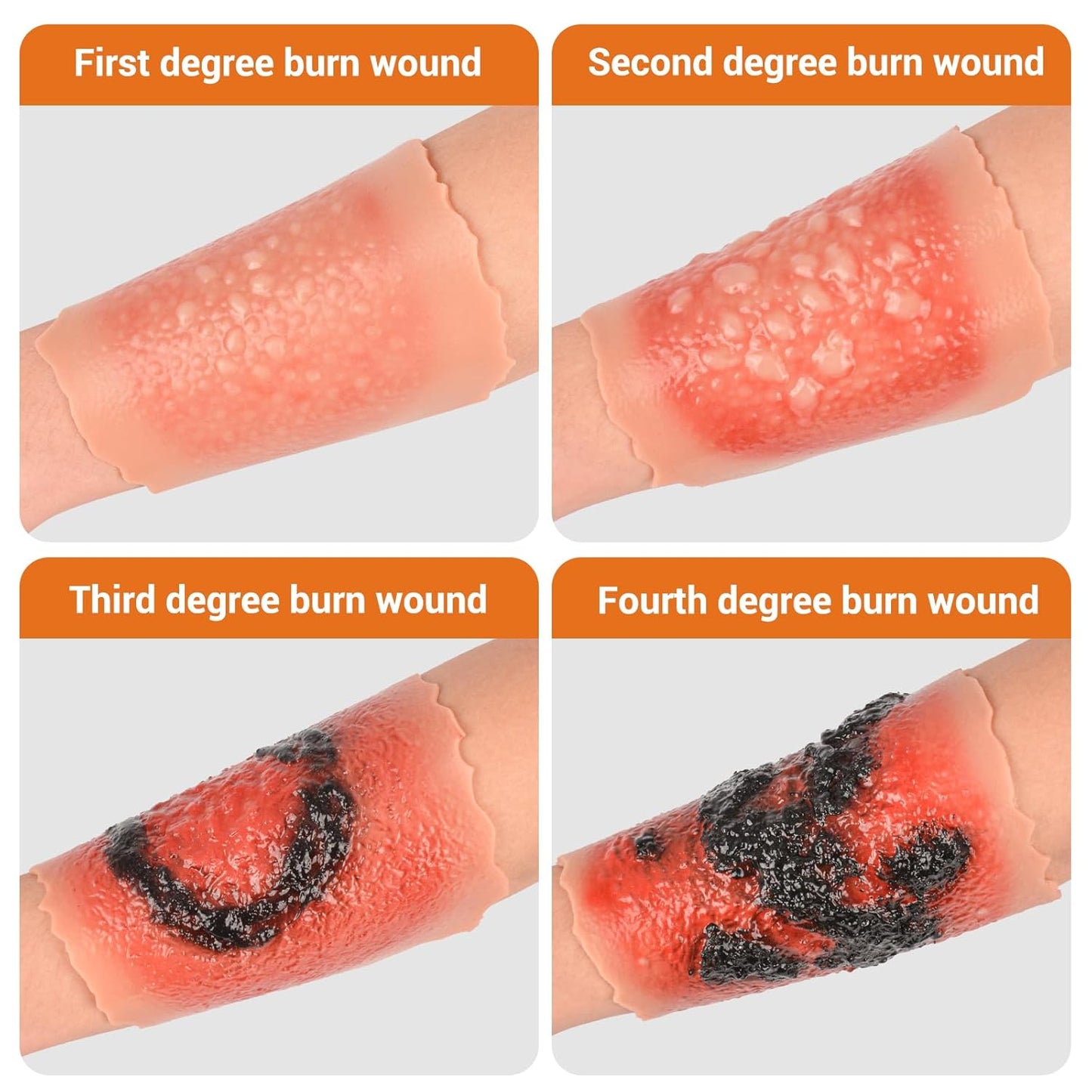 1st-4th Degree Skin Burn Wound Moulage