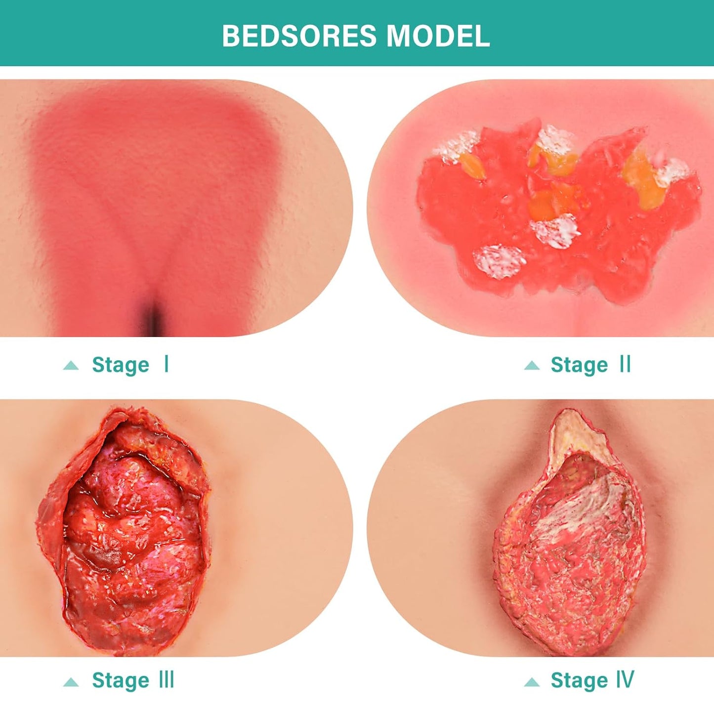 Pressure Ulcer/Bedsore Model Set(Stage 1-4) - [shop_medarchitect]