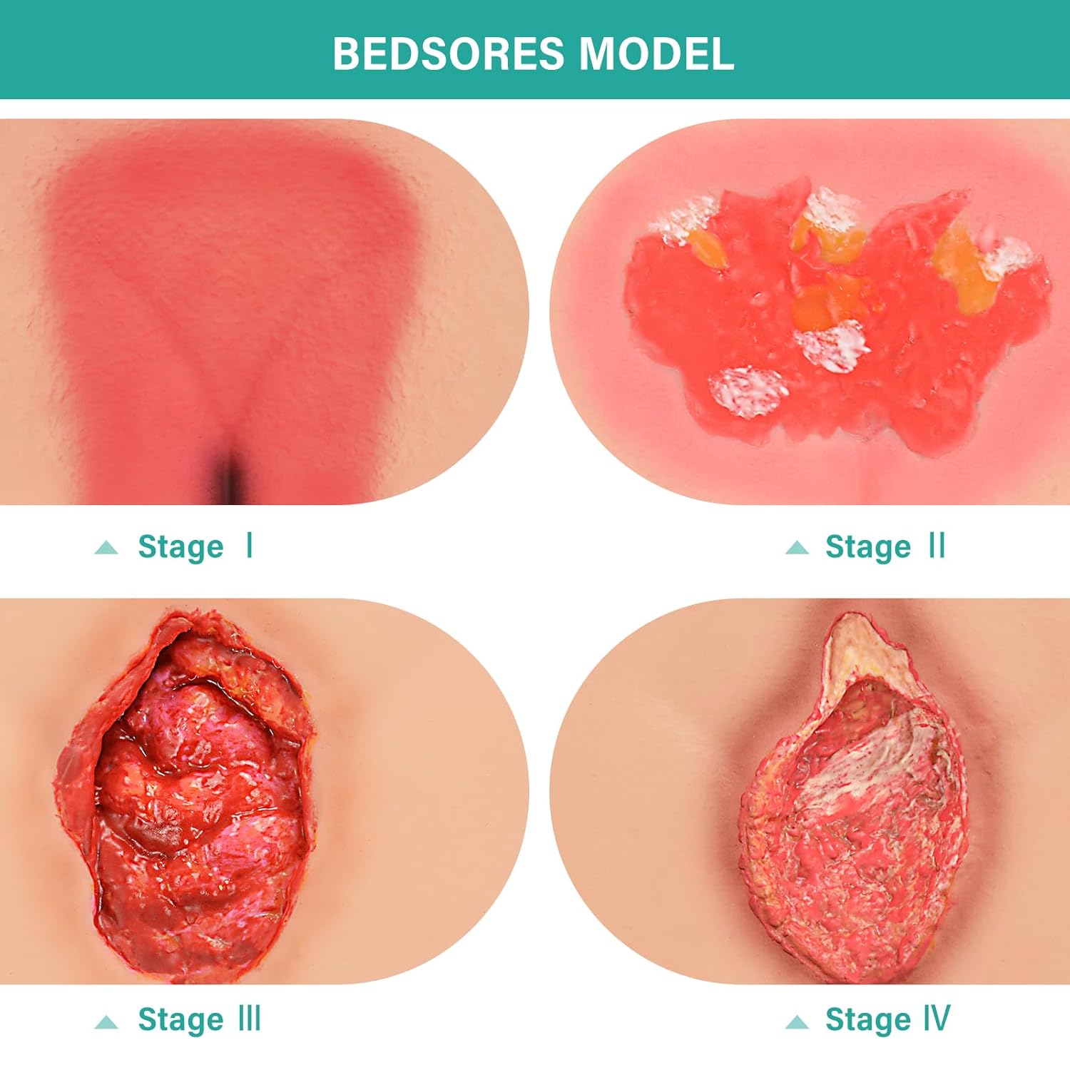 Pressure Ulcer/Bedsore Model Set(Stage 1-4) - [shop_medarchitect]