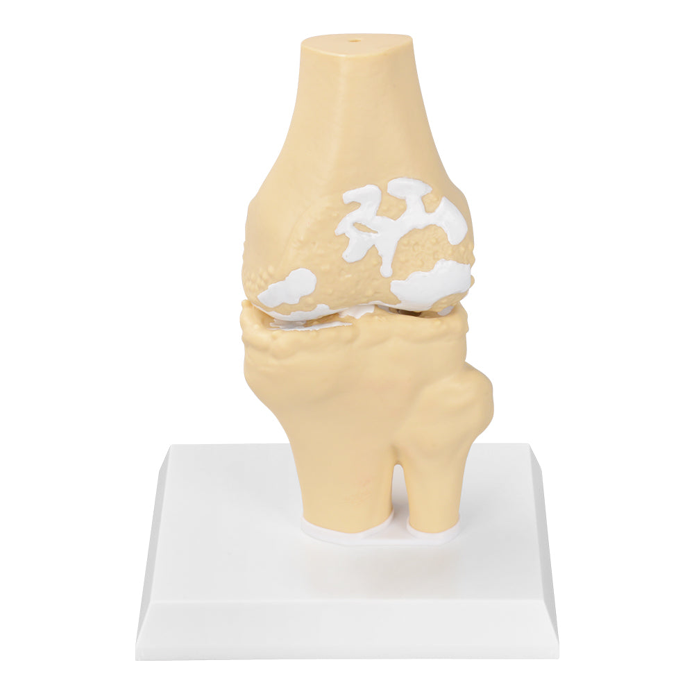 Arthritis Knee Model Showing Bone Spurs