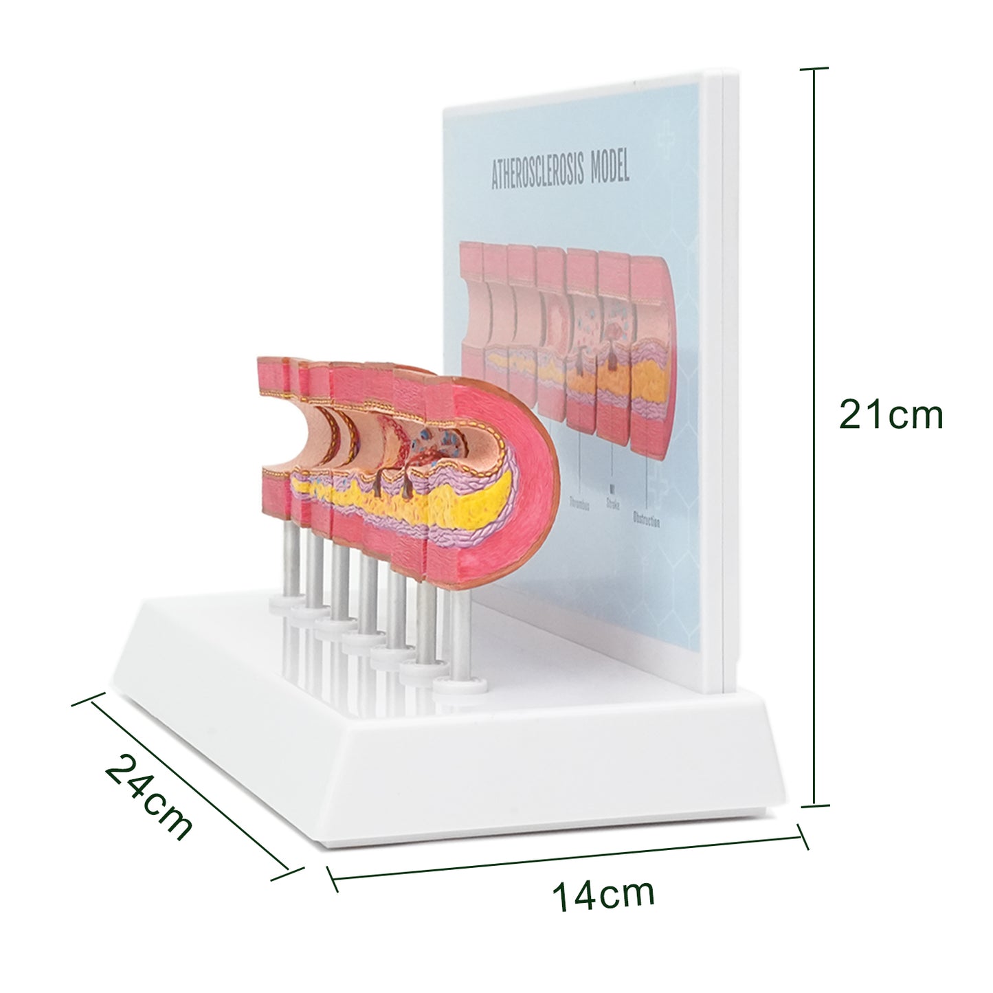 Atherosclerosis Model Showing Dimensions 24×14×21 Cm