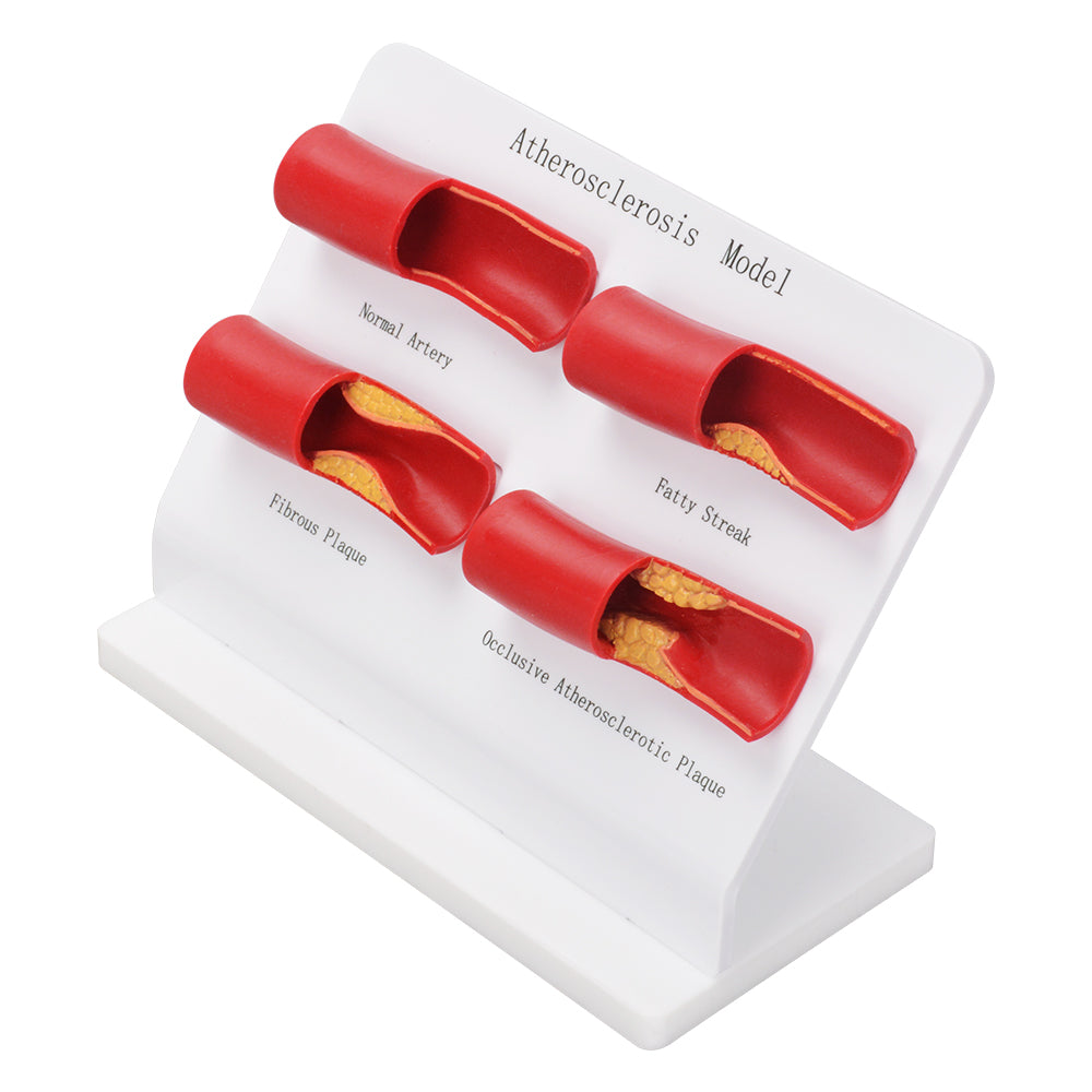 Atherosclerosis Model Showing Healthy Artery And Plaque