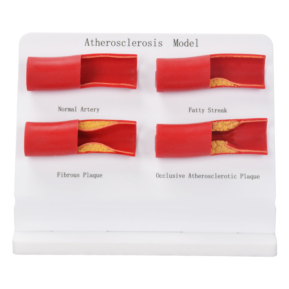 Atherosclerosis Model for Medical Education and Training