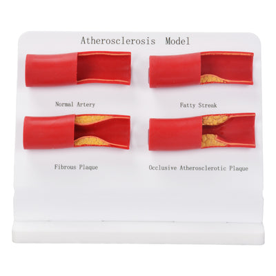 Atherosclerosis Model for Medical Education and Training