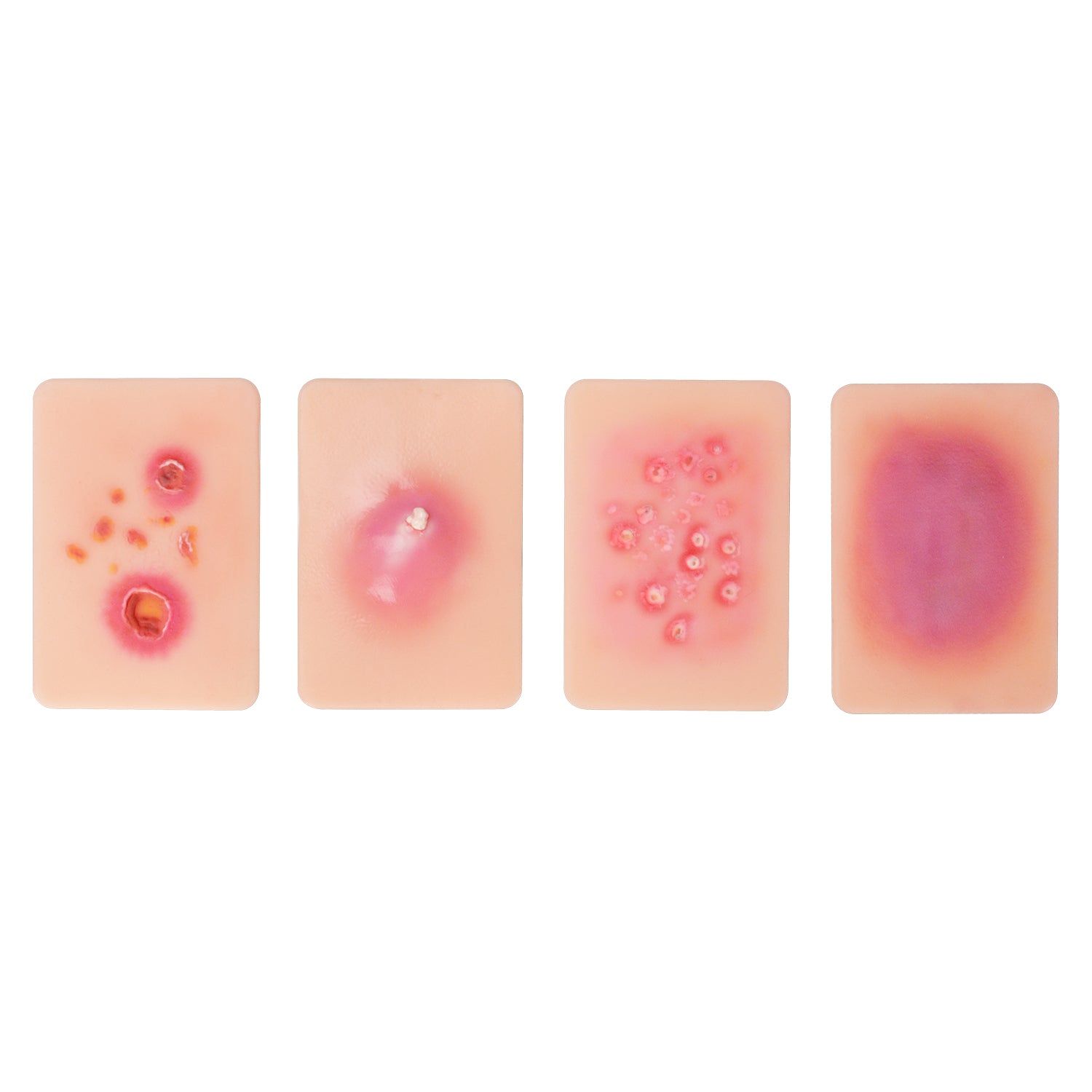 Bacterial Skin & Soft Tissue Infection Wound Simulation Models (Set of ...
