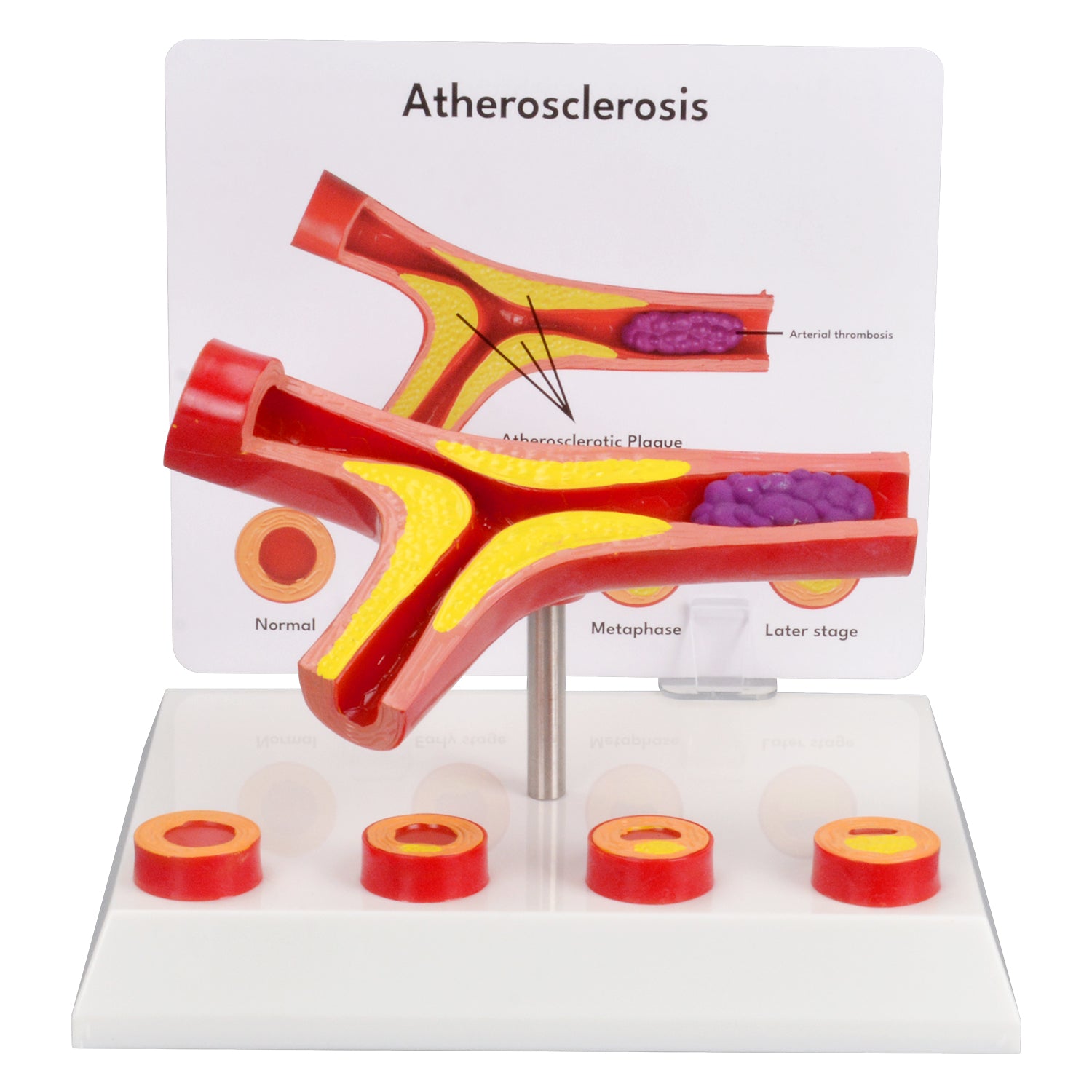 Bifurcated Atherosclerotic Vascular Anatomical Display Model