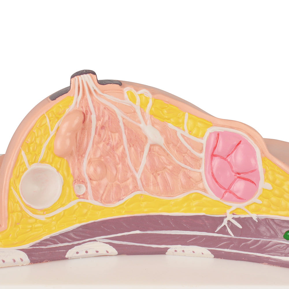 Breast Disease Anatomy Model