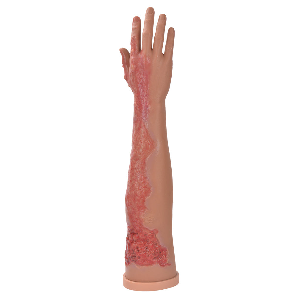 Burn Arm Training Model With Second And Third Degree Burns