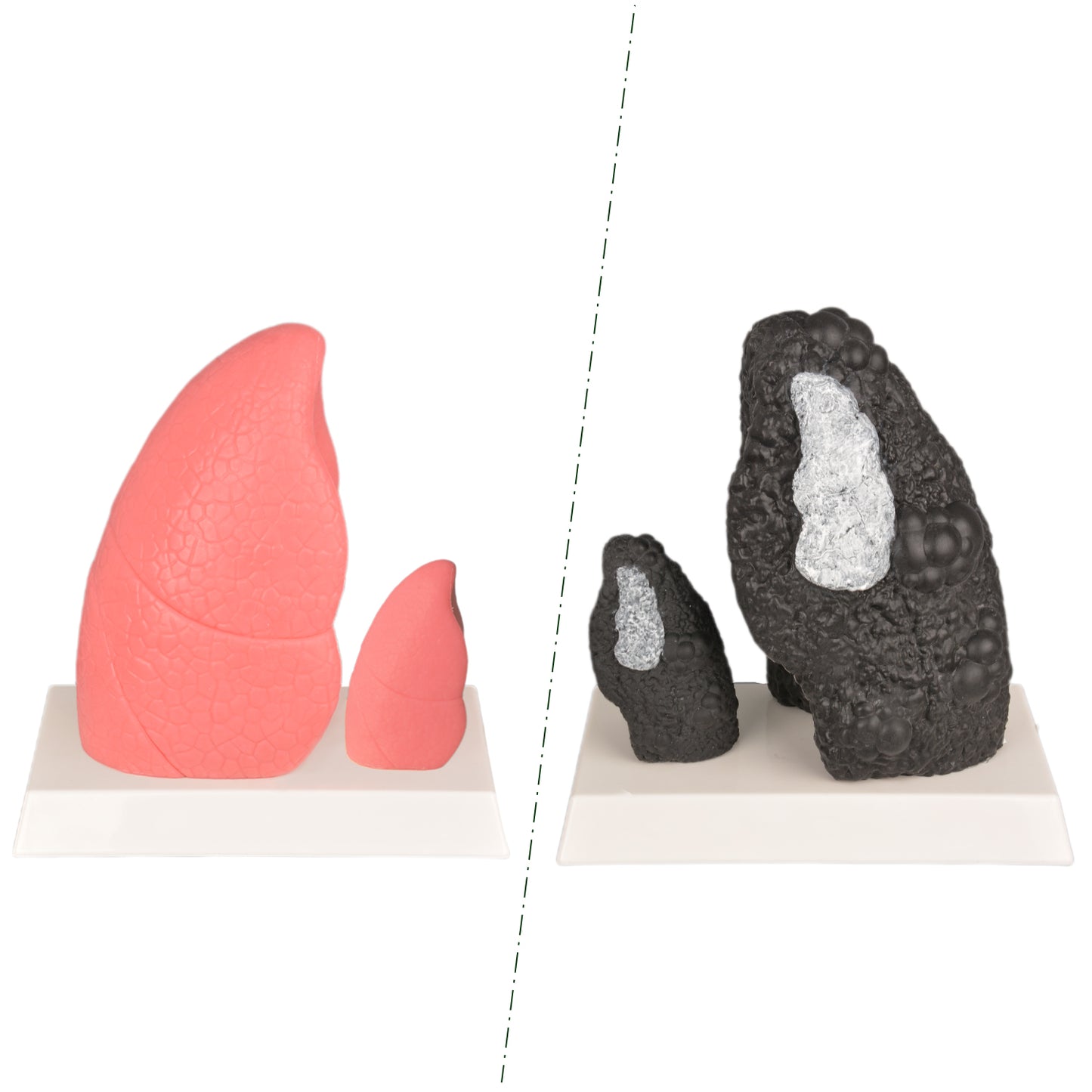 Smoking Damage Lung Demonstration Model