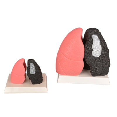 Healthy vs Smoker Lung Silicone Model Set