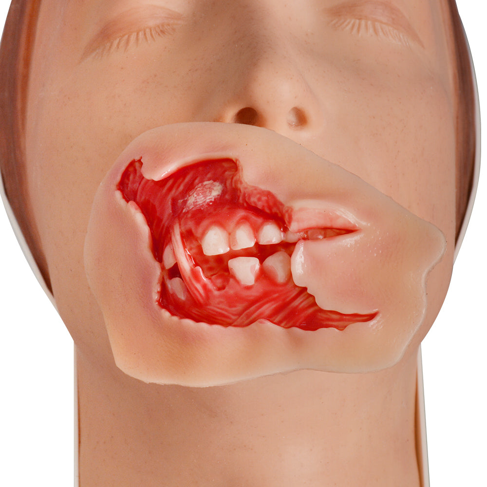 Wound Moulage – Maxillofacial Burn Wound Simulation Model