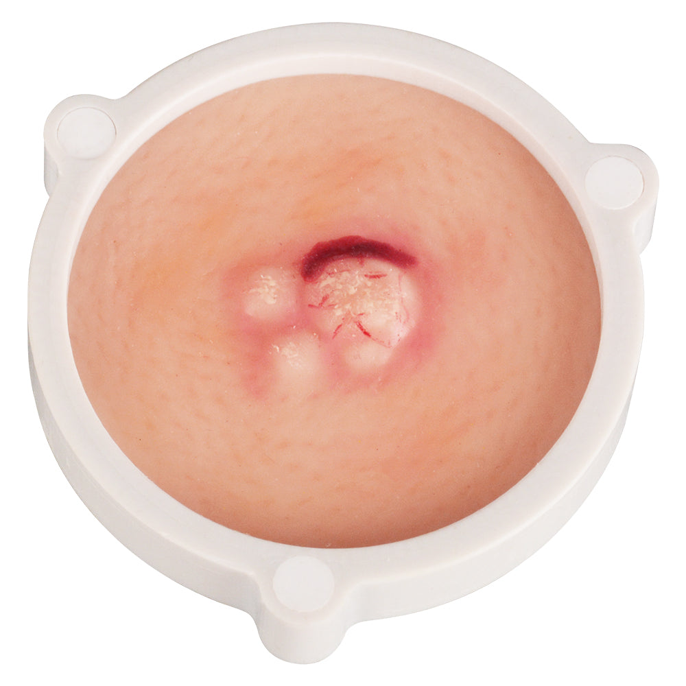 Human Skin Cancer Model for Dermatology Teaching & Training