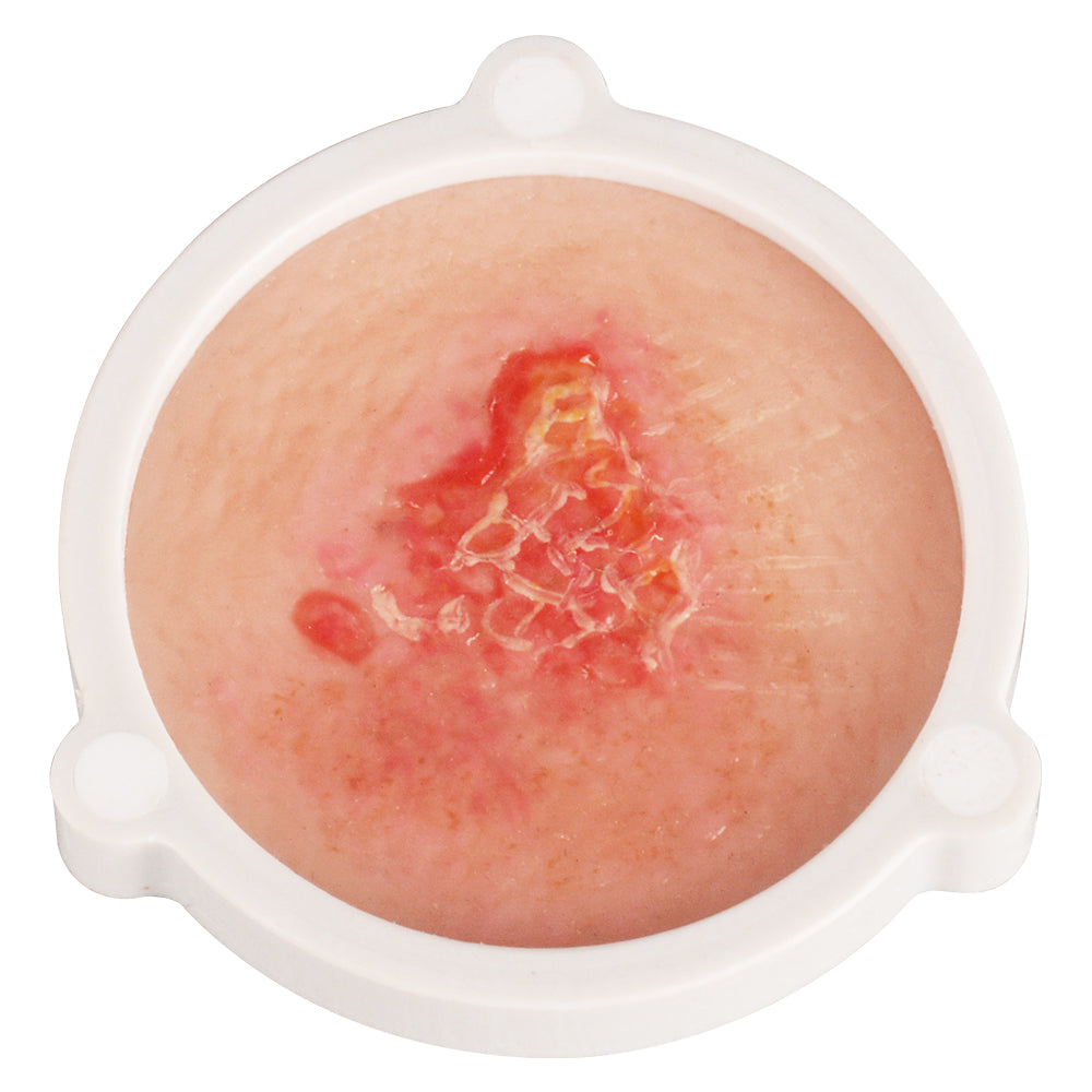 Human Skin Cancer Model for Dermatology Teaching & Training