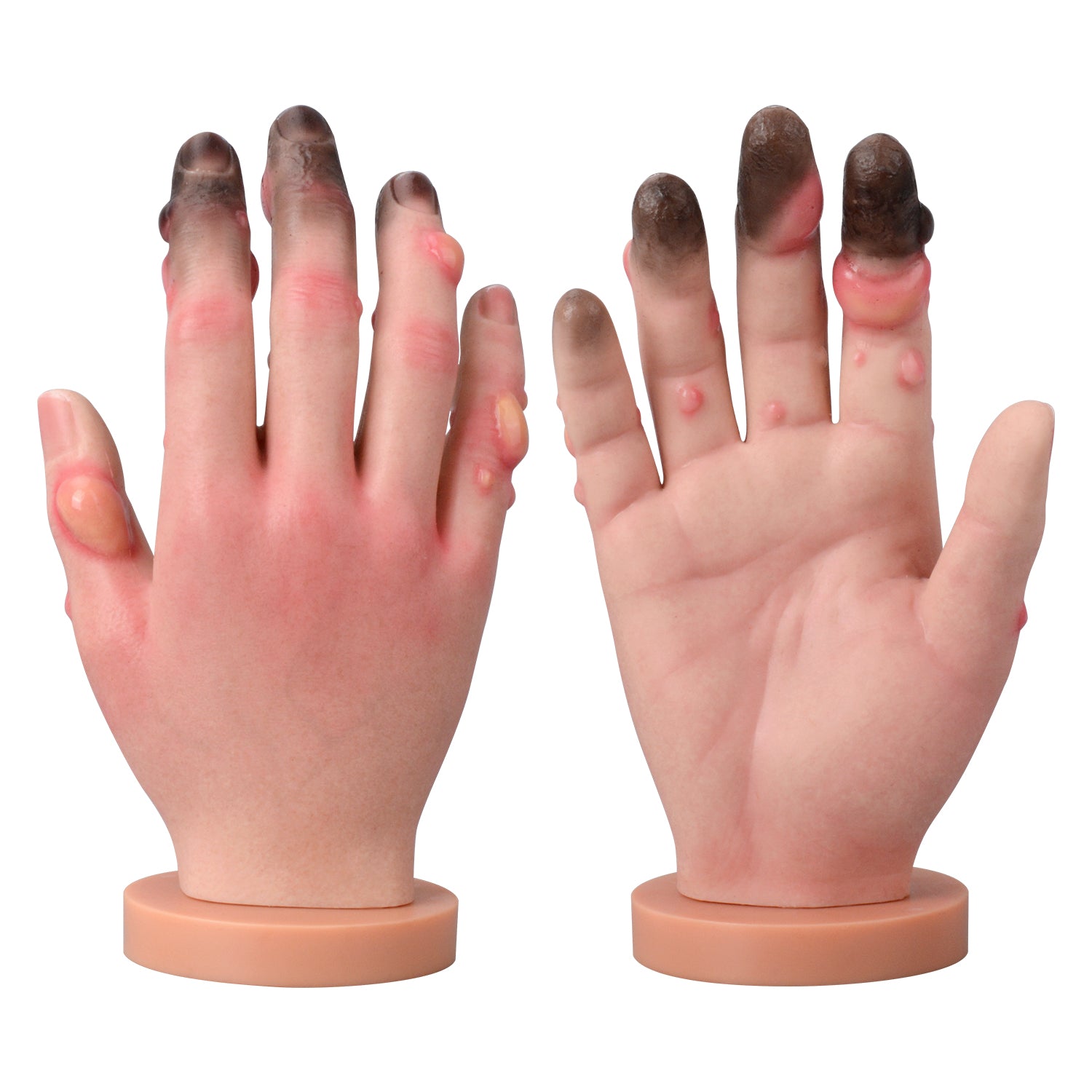 Hand Frostbite Training Model with Grade 1-4 Frostbite Symptoms
