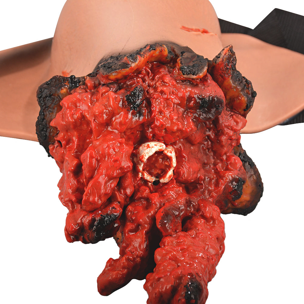 Close-Up Of Burned Edge Amputation Wound Details