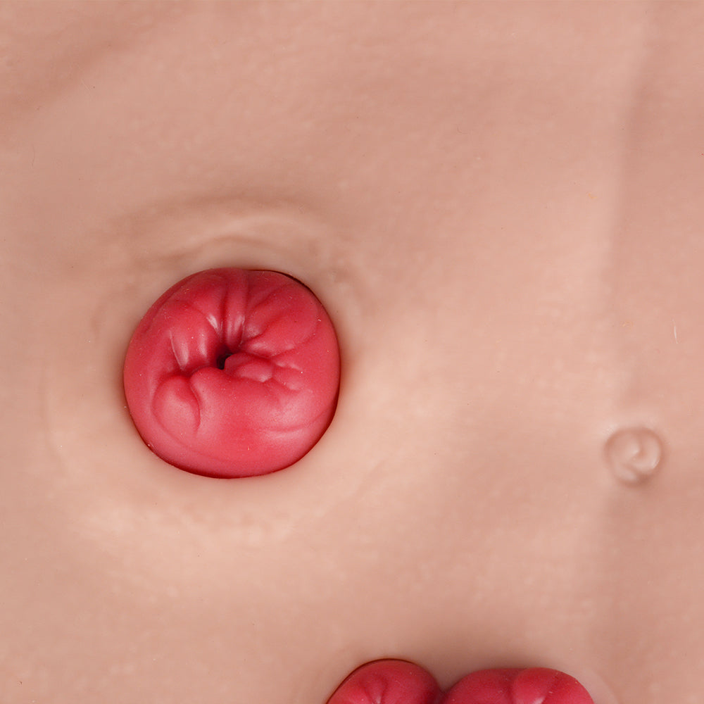 Colostomy Stoma Model