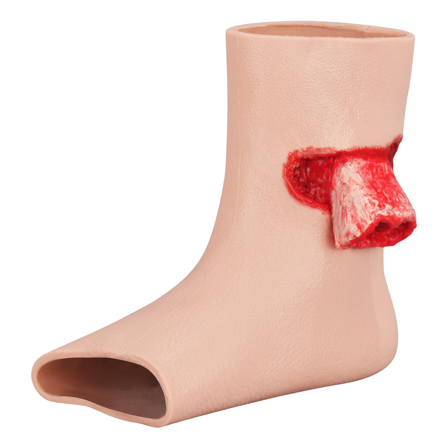 Complex Tibial Fracture Simulator On Right Foot