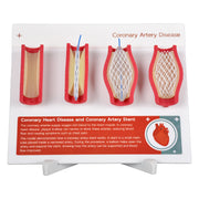 Coronary Artery Disease Model with Angioplasty and Stent