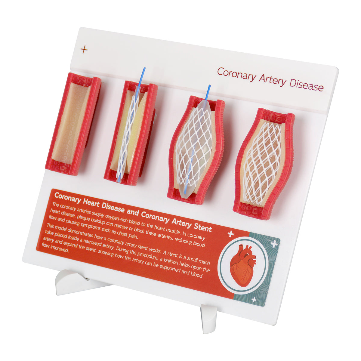 Coronary Artery Disease Model with Angioplasty and Stent