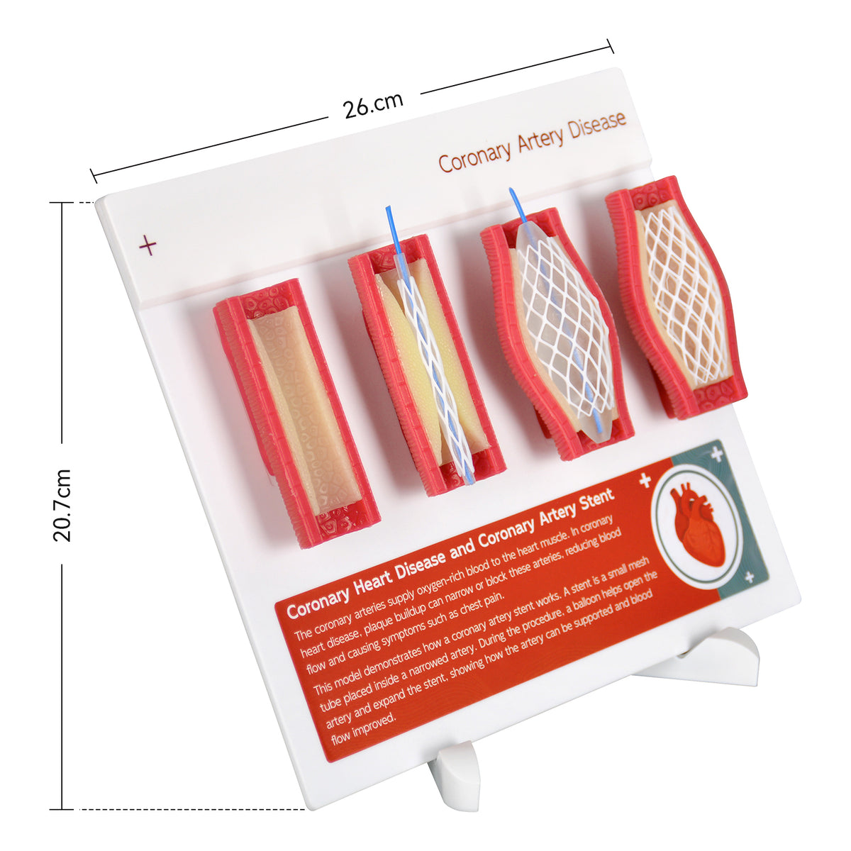 Coronary Artery Disease Model with Angioplasty and Stent