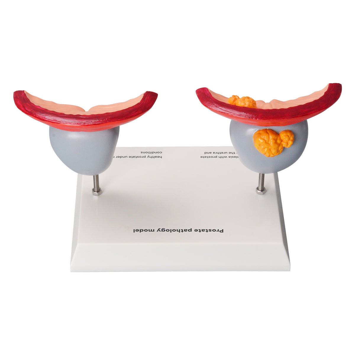 Prostate Scale Model Prostate Anatomy & Pathology Model – Medarchitect