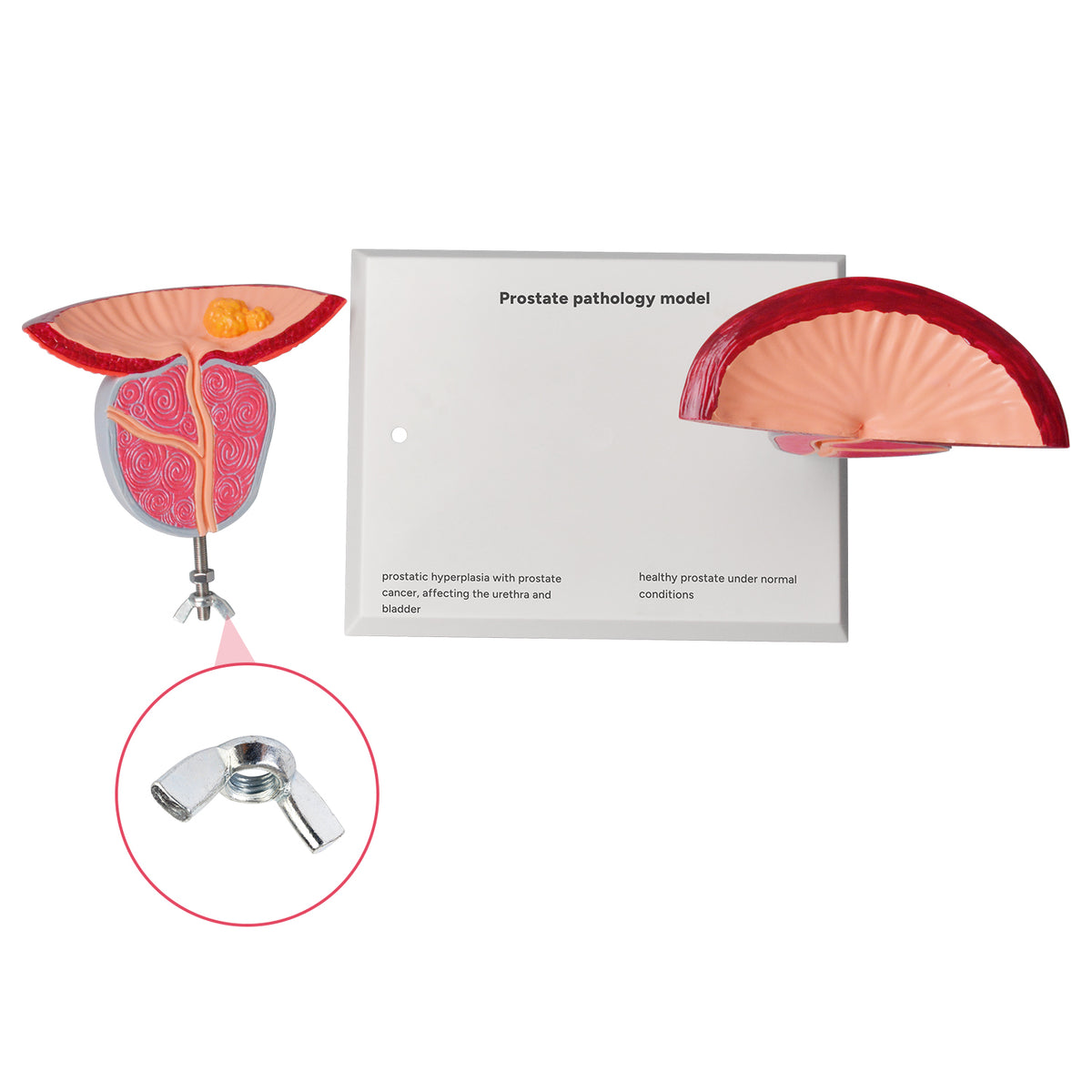 Prostate Scale Model Prostate Anatomy & Pathology Model – Medarchitect