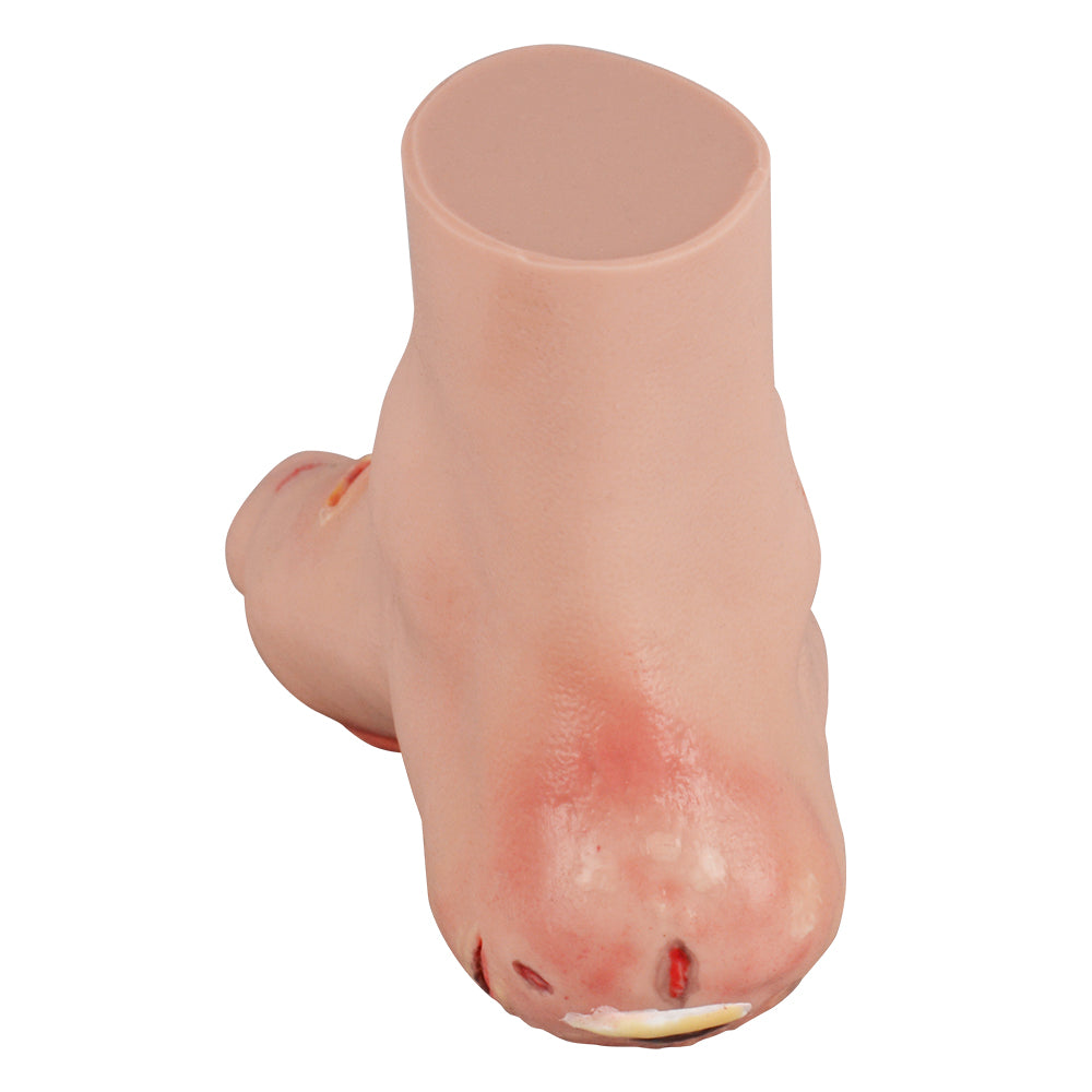 Educational Mild Diabetic Foot Model