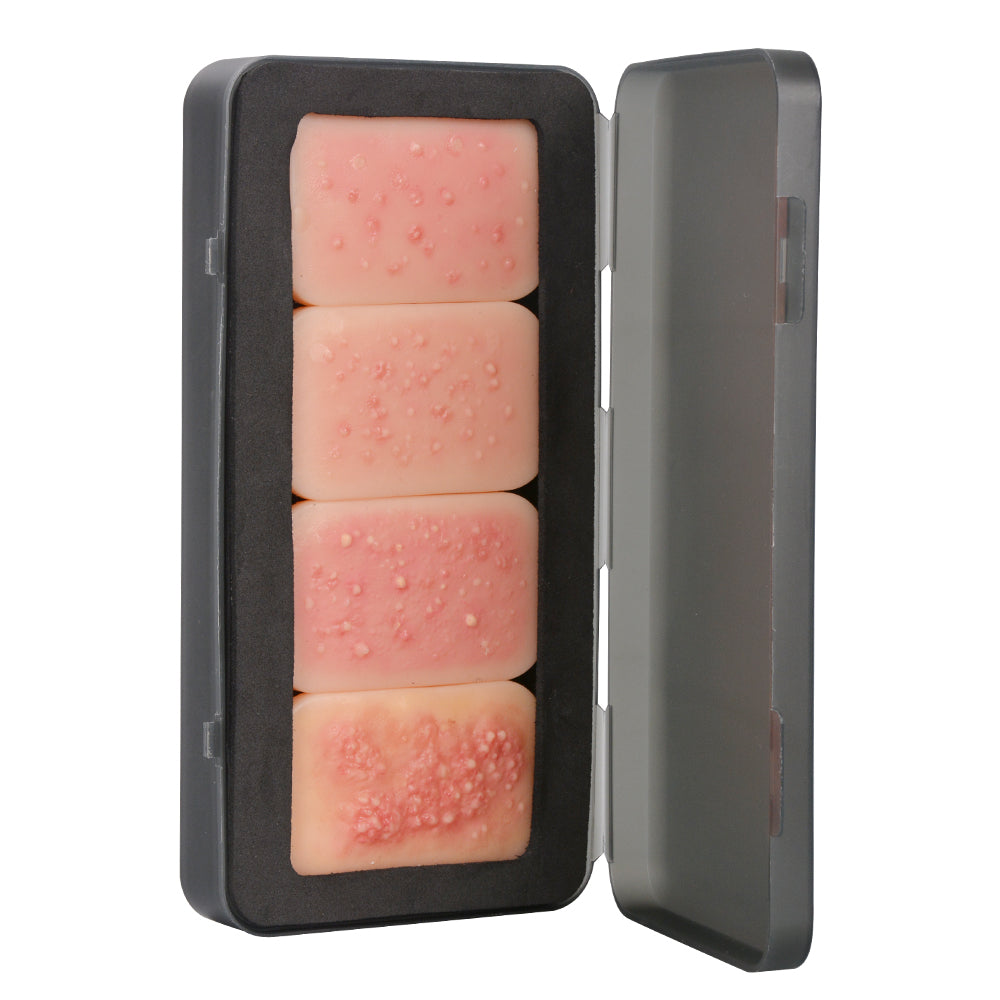 Facial Acne Pathology Teaching Model for Dermatology Training