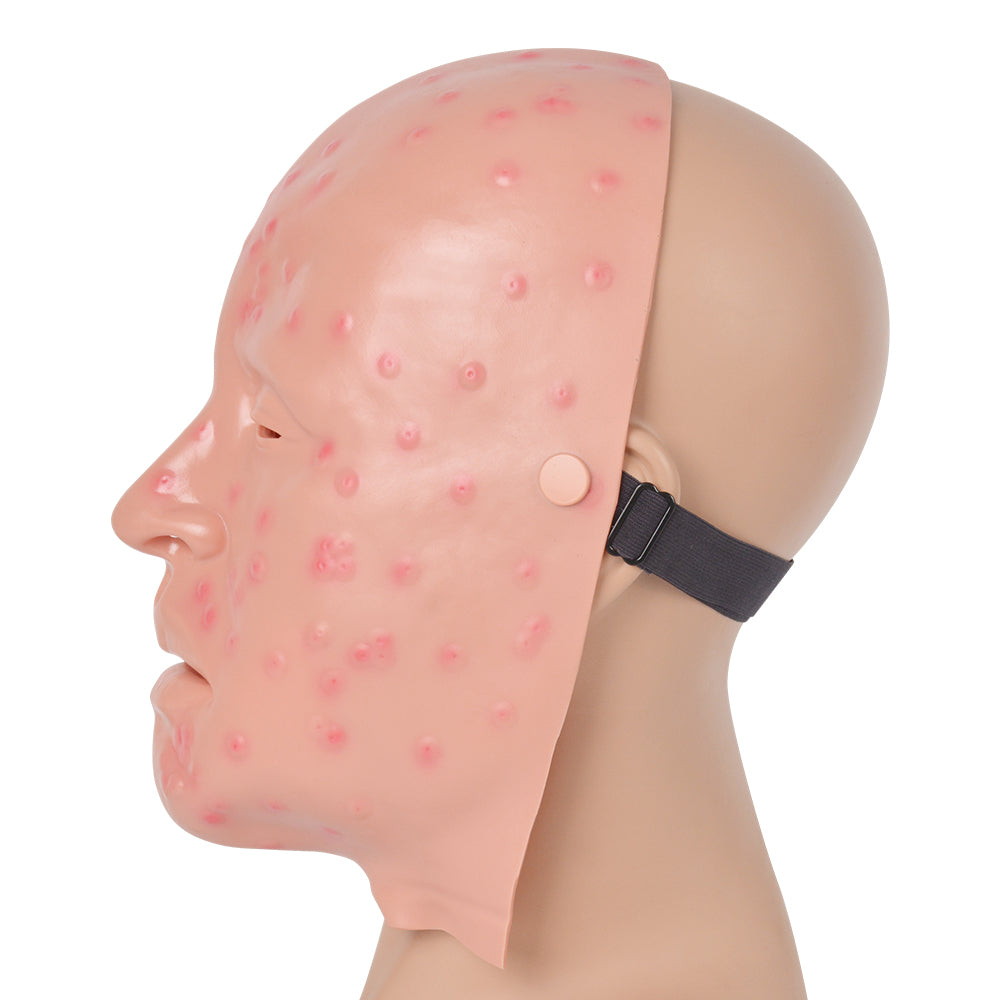 Facial Lesions On Forehead And Cheeks