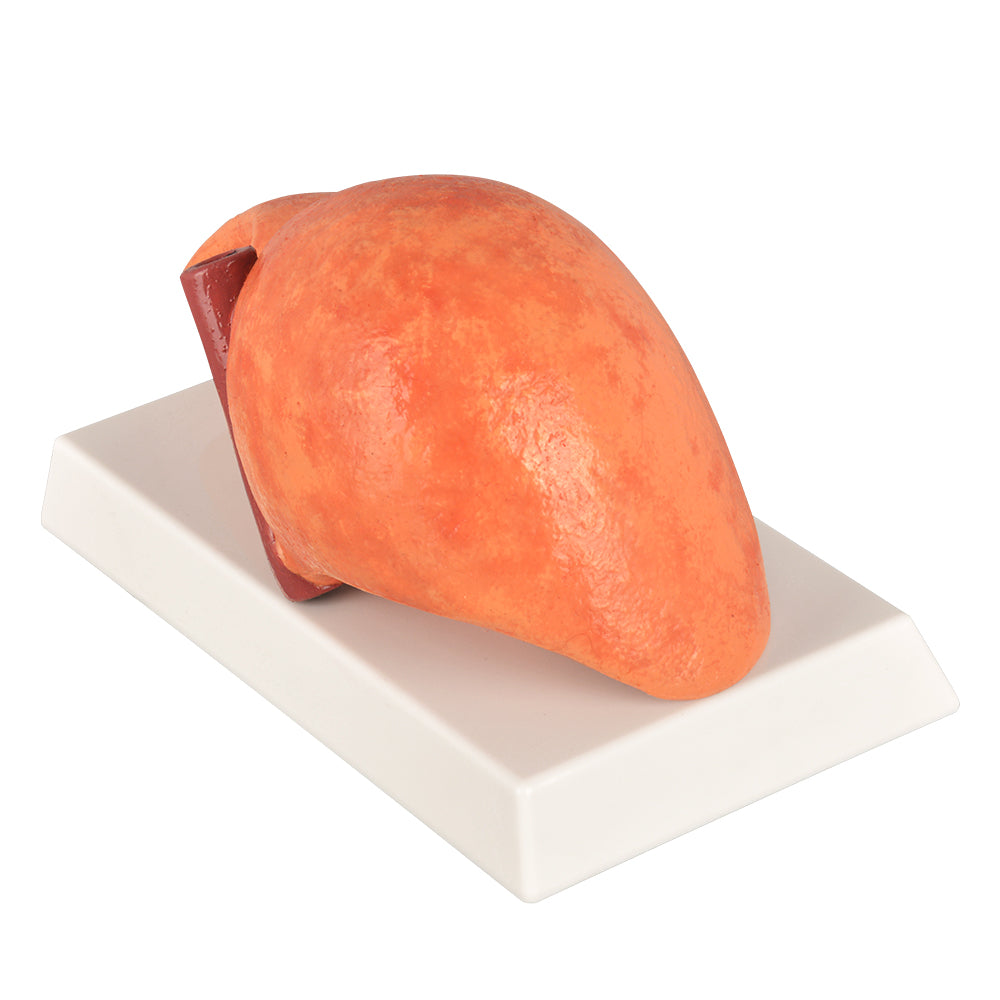 Fatty Liver Teaching Model
